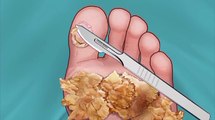 ASMR Treatment of foot Removal Animation