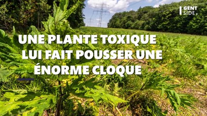 Une plante toxique lui fait pousser une cloque de la taille d’une pomme de terre