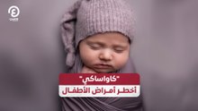 "كاواساكي" أخطر أمراض الأطفال