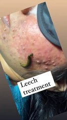 Leech sucks blood therpy