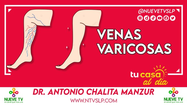 Venas varicosas