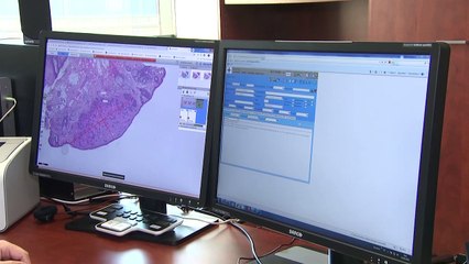 Video herunterladen: Avances en oncología y nuevos tratamientos están cambiando el pronóstico del cáncer de ovario