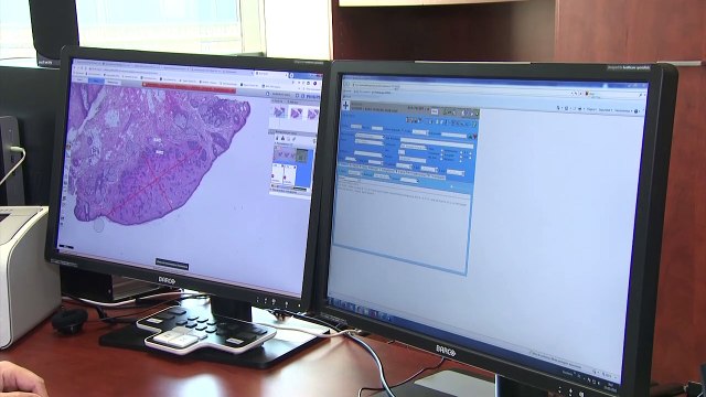 Avances en oncología y nuevos tratamientos están cambiando el pronóstico del cáncer de ovario