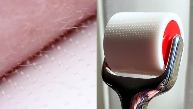 Microneedle tool has 3,000 dissolving needles that improve the appearance of skin