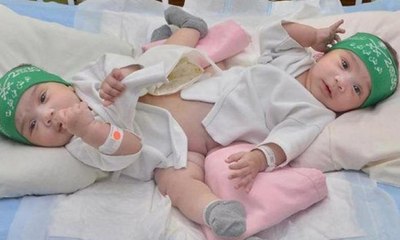 فيديو مؤثر لأول لقاء بين التوأم السيامي السوري ووالديهما