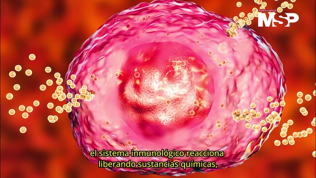 Día Mundial de la Alergia: Conoce los 5 tipos de alergias más comunes - #ExclusivoMSP