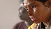Scarred survivors: India’s women rise up after acid attacks