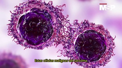 Día Internacional del Sarcoma: ¿Qué es y cómo funciona este tipo de cáncer? - #EspecialMSP