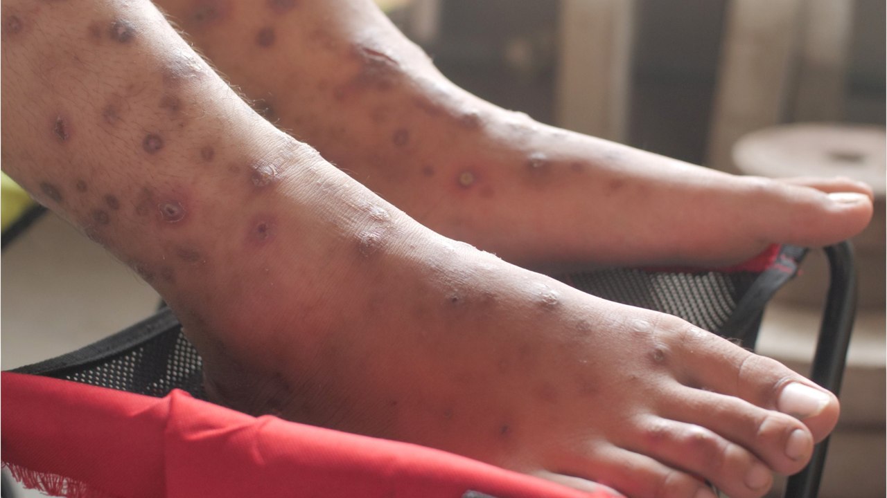 Krätze in Deutschland wieder auf dem Vormarsch - was Sie wissen müssen