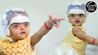 UAE helps twin girls born with deformed skulls bounce back