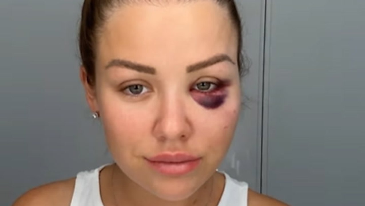 12 Stunden Krankenhaus: Kim Gloss hatte Unfall