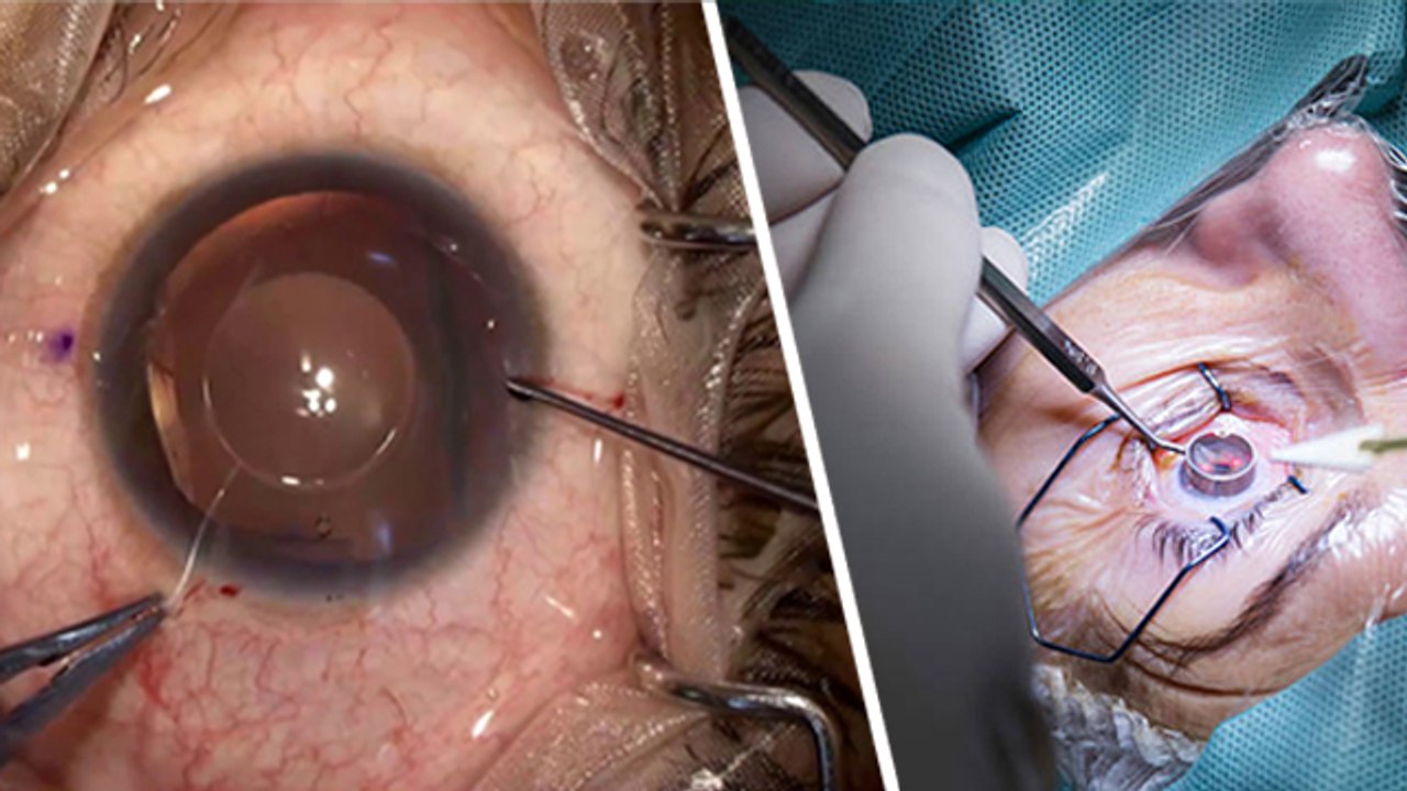ICL Surgery Kya Hai | ICL Surgery is Good Or Bad | Boldsky