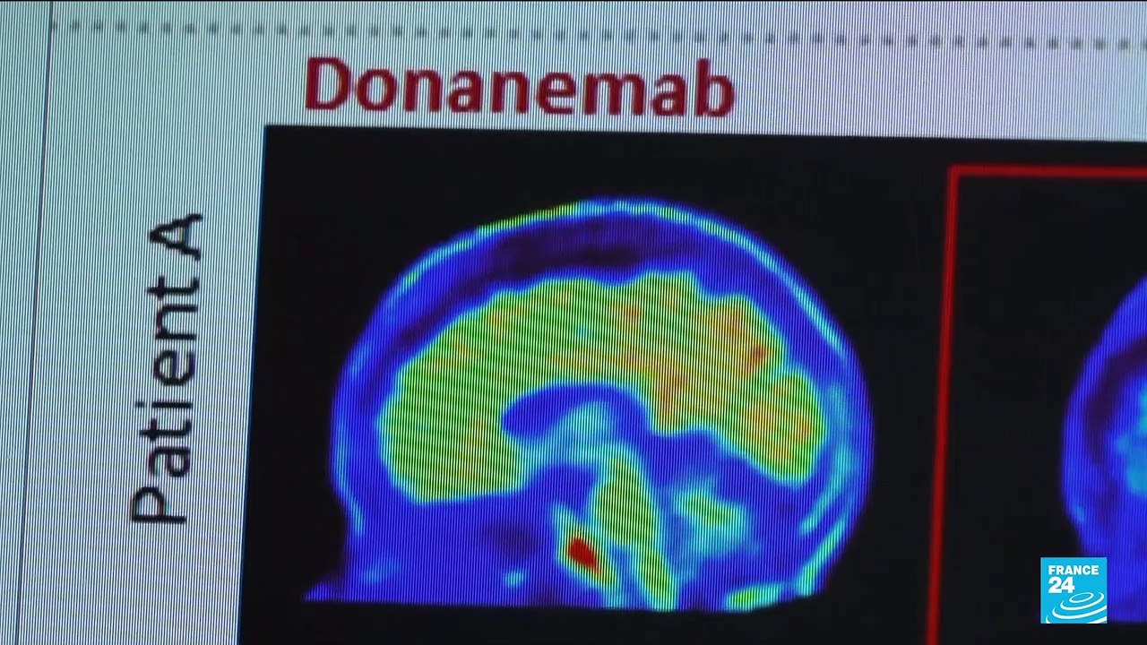 Nouvel espoir contre la maladie d'Alzheimer : les essais cliniques d'un médicament plutôt concluants