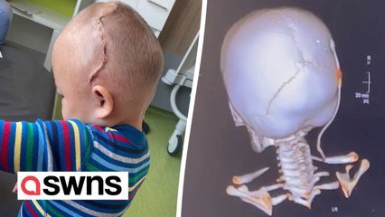 Boy's skull put back together 'like a jigsaw' after life-saving op to stop his brain being crushed