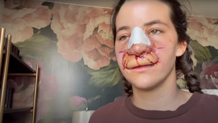 She Was Attacked by a Dog and Lost Her Lip