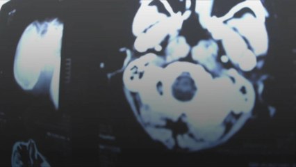 New Drug Shows Promising Results in Fight Against Alzheimer's