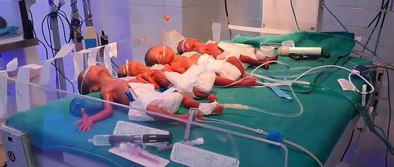 अनूठा मामला--जिला चिकित्सालय में महिला ने एक साथ चार बच्चों को दिया जन्म
