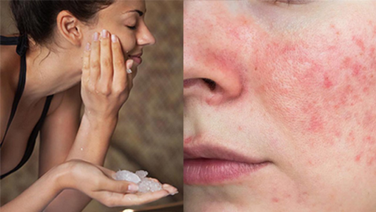 चेहरे पर फिटकरी लगाने के नुकसान | Chehre Par Fitkari Lagane Ke Nuksan | Boldsky