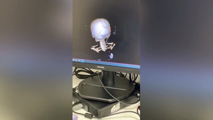 Yorkshire doctors dismantle and rebuild toddler's skull in life-saving operation