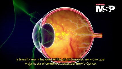 ¿Cómo funciona la miopía? - #ExclusivoMSP