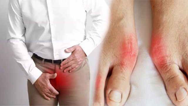 High Uric Acid से Prostate Cancer का खतरा कैसे | हाई यूरिक एसिड से प्रोस्टेट कैंसर हो सकता है क्या