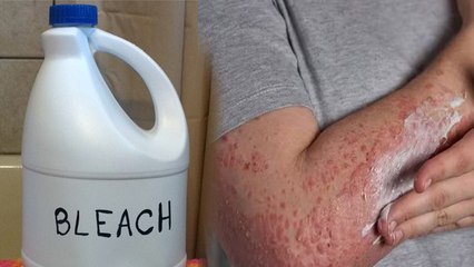 Monsoon Eczema को Bleach से Remove करने का बेहद आसान तरीका | Boldsky