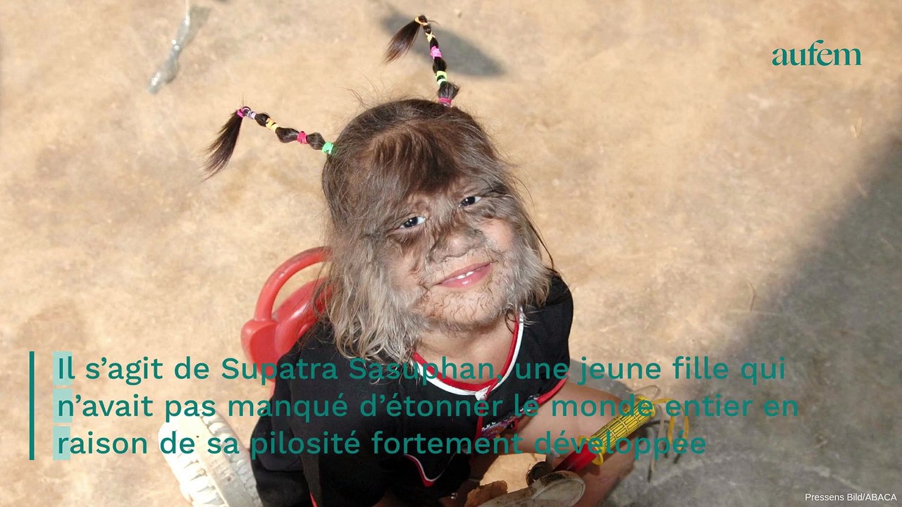 La "fille la plus poilue du monde" est méconnaissable aujourd'hui