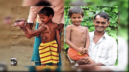 7 People With Weird Extra Body Parts