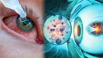 आई फ्लू ठीक कैसे करें | Eye Flu Thik Kaise Karein | आई फ्लू का इलाज और घरेलू उपाय | Boldsky