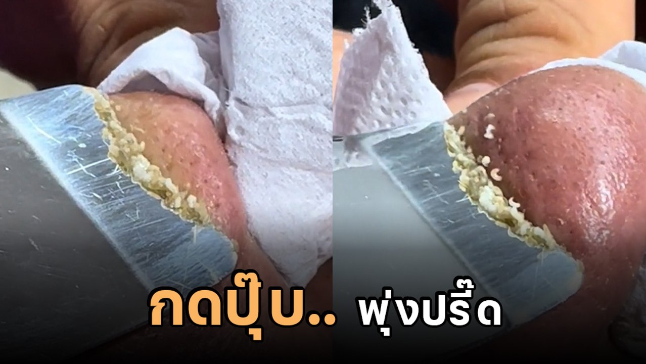 ไวรัล 18 ล้าน ! กดสิวเสี้ยนที่จมูก ดูแล้วสยอง แ...