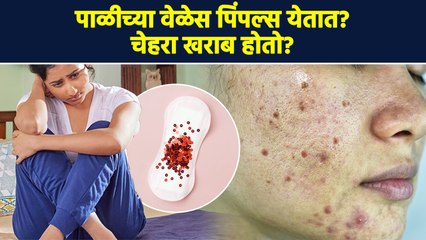 पाळीच्या दिवसात चेहऱ्यावर फोड-पिंपल्स येतात | Skincare Tips To Prevent Acne During Periods | AI2