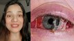 Eye Flu Ayurvedic Treatment | Eye Flu Home Treatment In Hindi | Eye Flu Hone Par Kya Karen | Boldsky