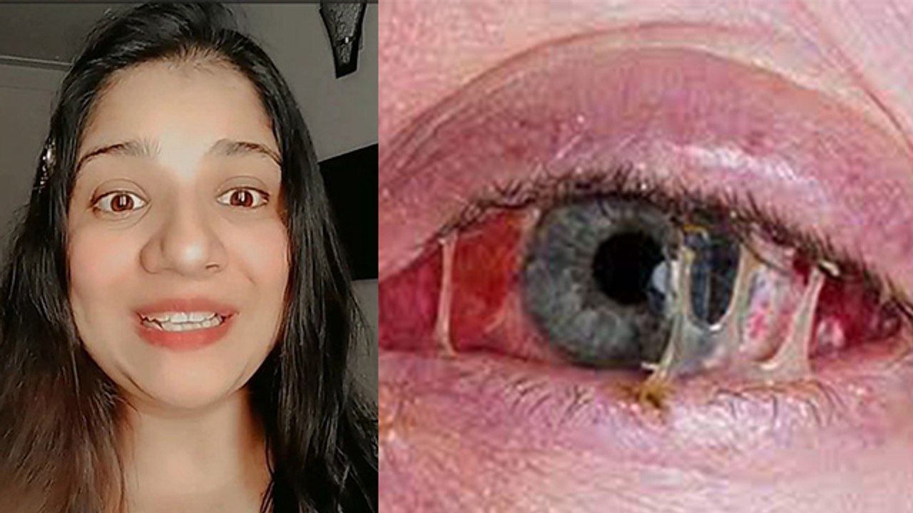 Eye Flu Ayurvedic Treatment | Eye Flu Home Trea...