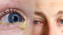 Viral Conjunctivitis से लेकर Allergic Conjunctivitis Eye Flue Types में कौन सा Most Dangerous