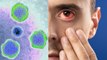 Eye Flu Kis Virus Se Hota Hai, Adenovirus क्या है | आई फ्लू किस वायरस से फैल रहा है | Boldsky