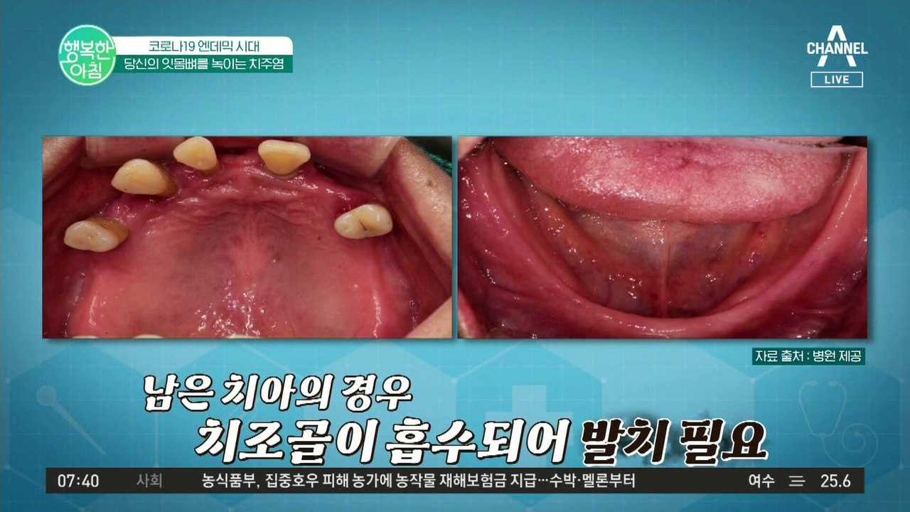 마스크 벗기 싫어 치과 안 가다가 잇몸뼈 녹았다?! #치주염