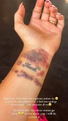 Elettra Lamborghini disperata, mostra i segni sul corpo