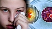 आई फ्लू होने पर क्या करें | Eye Flu Hone Par Kya Karen | Boldsky