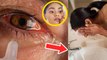 आई फ्लू होने पर क्या ना करें | Eye Flu Hone Par Kya Kare Kya Na Kare | Boldsky