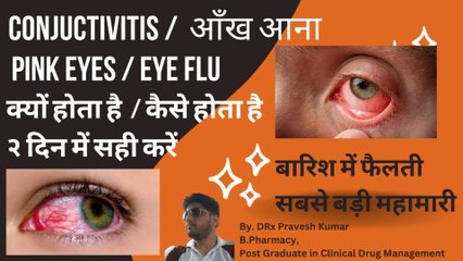 CONJUCTIVITIS | SYMPTOMS | TREATMENT | आँख चिपकने का इलाज | EYE INFECTION | पहले दिन से आराम शुरू