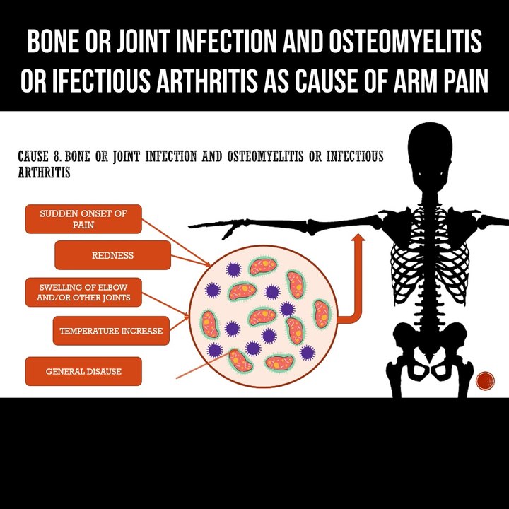 Bone or joint infection and osteomyelitis or infectious arthritis as ...