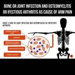Bone or joint infection and osteomyelitis or infectious arthritis as cause of arm pain