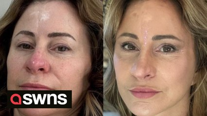 “I sold my house to help afford a $14k facelift – strangers tell me I look 20 years younger”