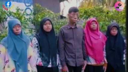 عائلة يتغير شكلها يوميا  لن تصدق هذا المرض النادر 