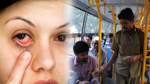आई फ्लू में पब्लिक ट्रांसपोर्ट इस्तेमाल कैसे करें | Eye Flu Me Public Transport Ka Use Kaise Kare