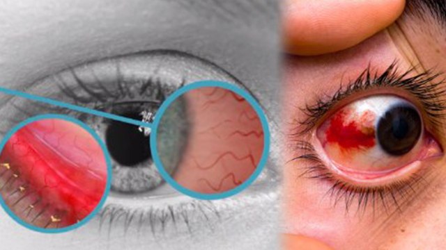 Eye Flu Like Symptoms हर बार Conjunctivitis नहीं, Dry Eye से लेकर Subconjunctival Haemorrhage Reason