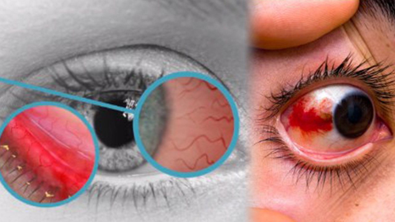 Eye Flu Like Symptoms हर बार Conjunctivitis नहीं, Dry Eye से लेकर Subconjunctival Haemorrhage Reason