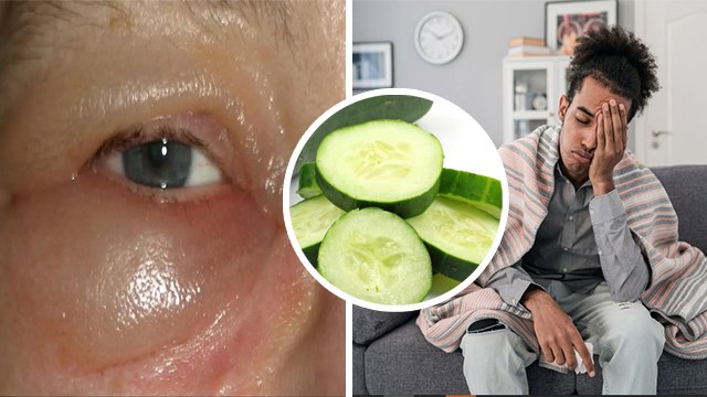 फ्लू में आंखो की सूजन कैसे कम करें | Flu Me Eye Swelling Kaise Kam Kare | Boldsky