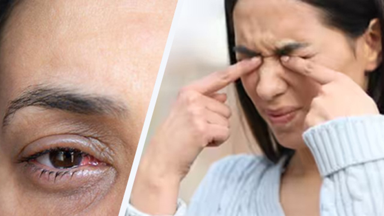 आई फ्लू ठीक होने के बाद कैसे रखें ख्याल | Eye F...