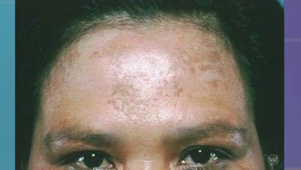 bd-melasma-causas-y-tratamientos-030823